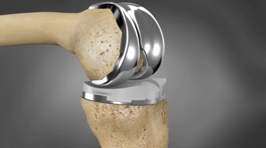 3D Printing a New Knee. Now possible!