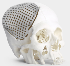 Cranial implant in Ti64 alloy customized to a patient’s anatomical requirements. (image source: Imaginarium)